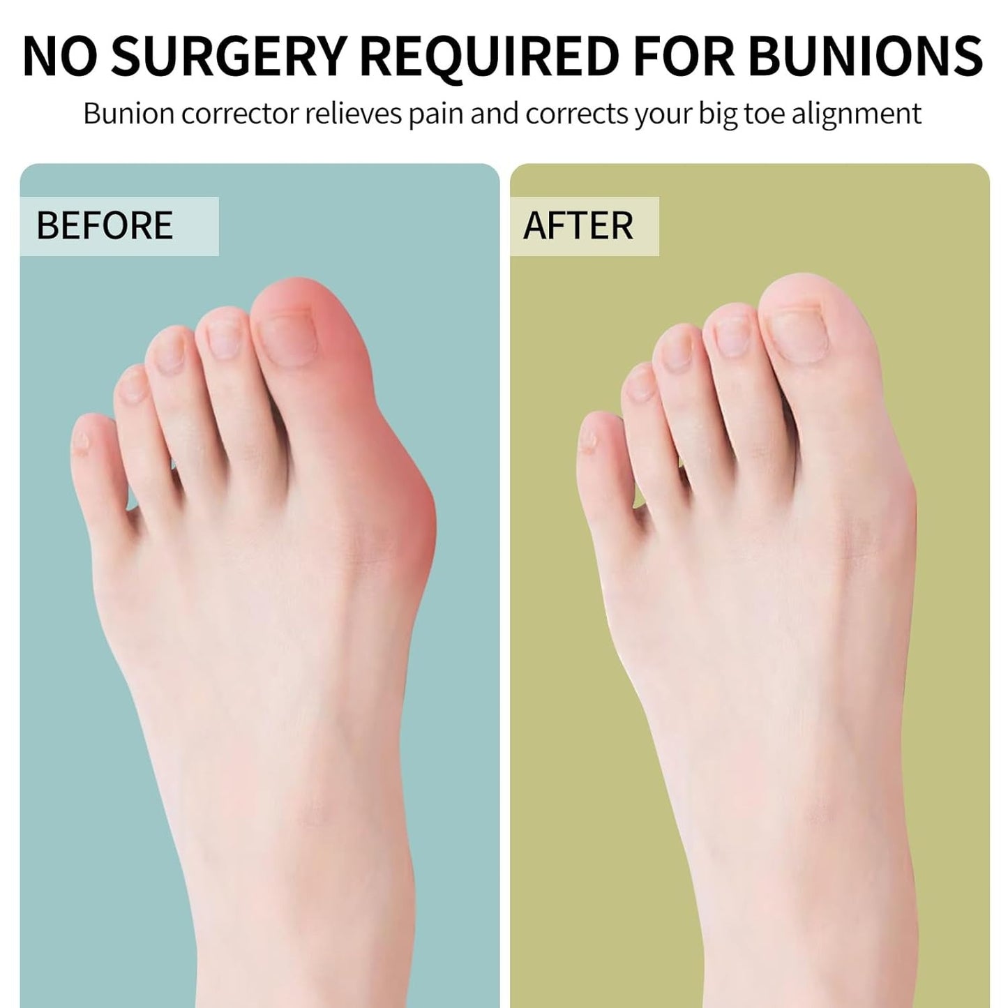 Adjustable Bunion Corrector