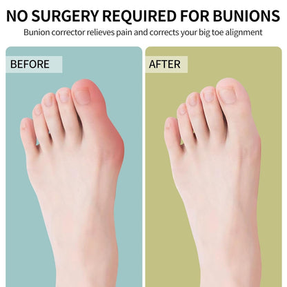 Adjustable Bunion Corrector